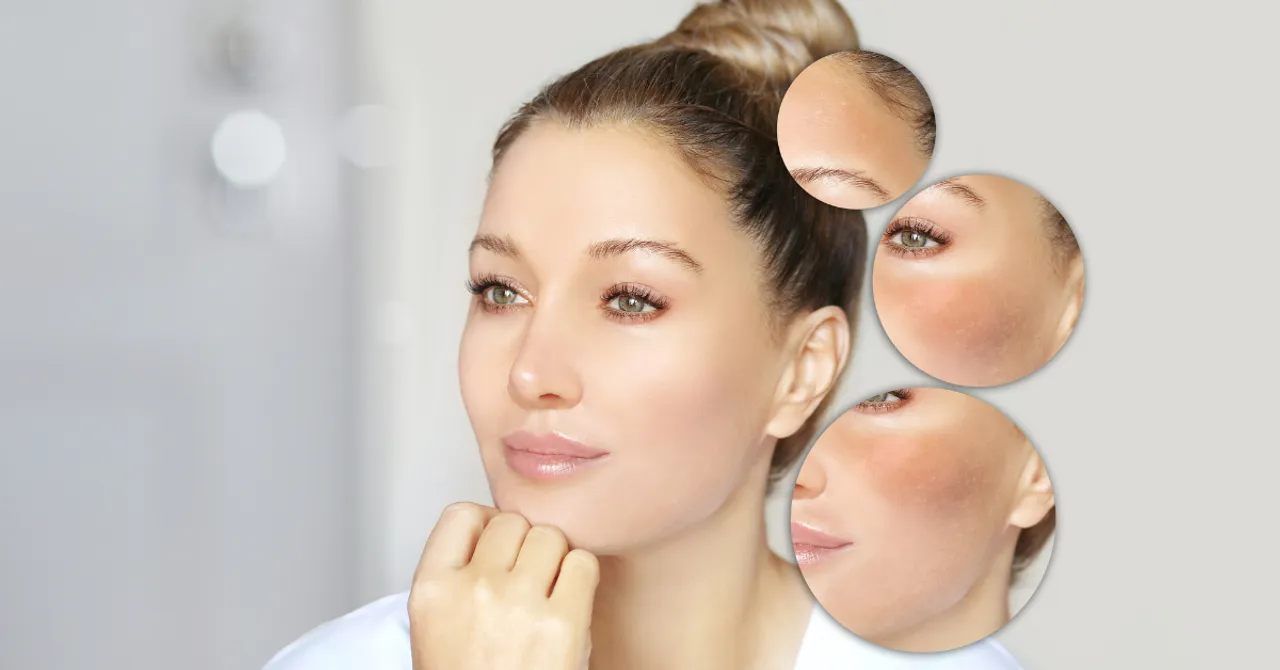 A woman with clear skin and close-up views of dry patches, illustrating skincare concerns for summer.